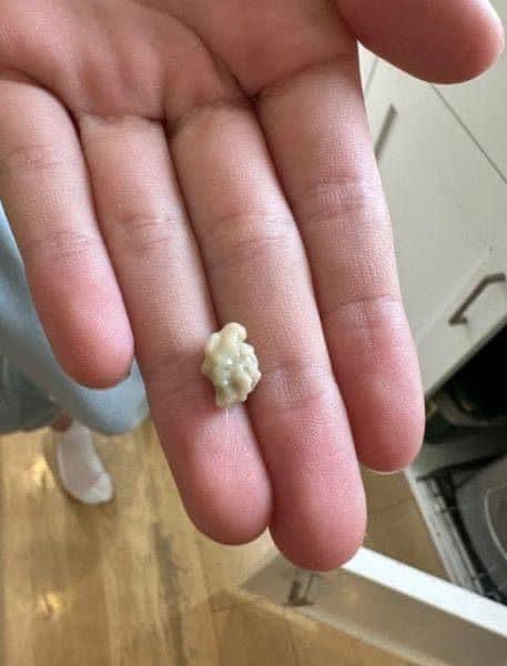 Here’s What You Need to Know About Tonsil Stones….Detail in comment.
