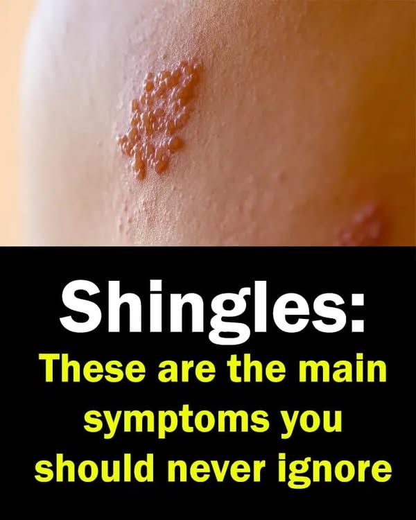Shingles: Symptoms, Complications and Prevention…