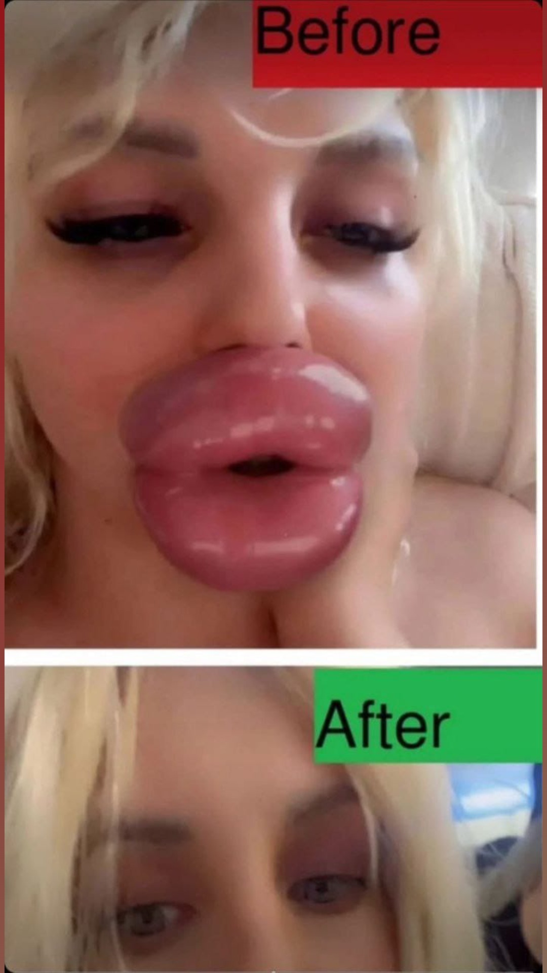 25-Year-Old Bulgarian Woman Has More Than 27 Procedures To Have The Biggest Lips In The World