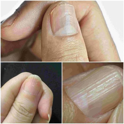 Understanding Why You Have Lines on Your Nails