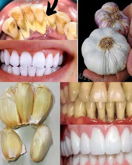 Improve Your Oral Health Naturally with Garlic