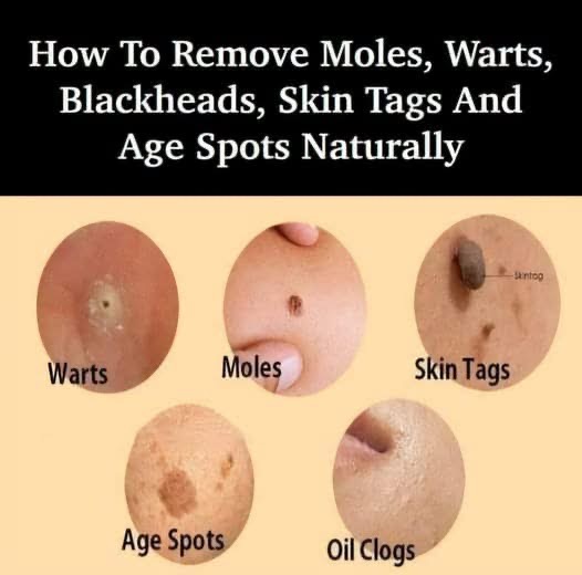 Natural Skin Care: What Can You Try To Remove Age Spots, Moles, Skin Tags, Warts, And Blackheads?