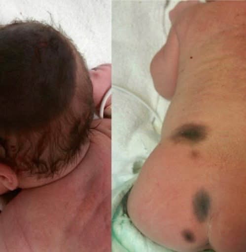 Mom doesn’t dare go outside with baby born with black spots