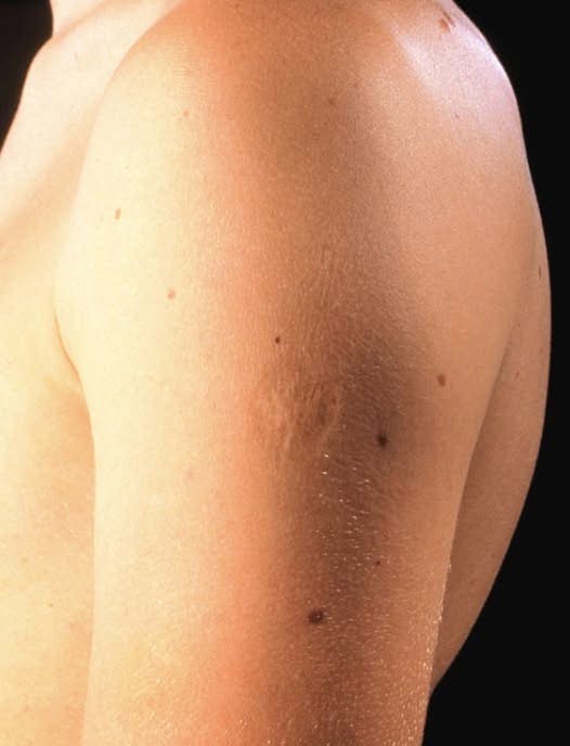 Here’s The Truth Behind This Scar On People’s Upper Left Arm