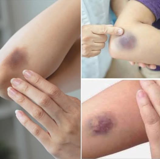BE CAREFUL, if you get these bruises on your body, here’s what…