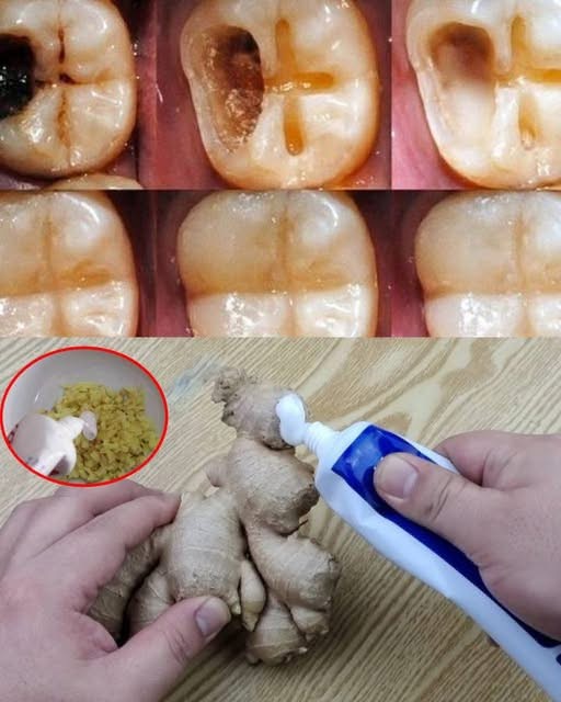 How to naturally repair a cavity. Keep these tips in mind to avoid visiting the dentist