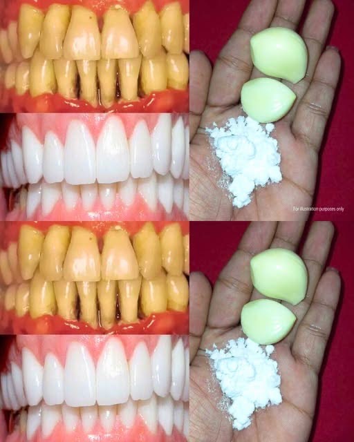 Naturally Whiten Yellow Teeth with Garlic & Salt (100% Effective!)