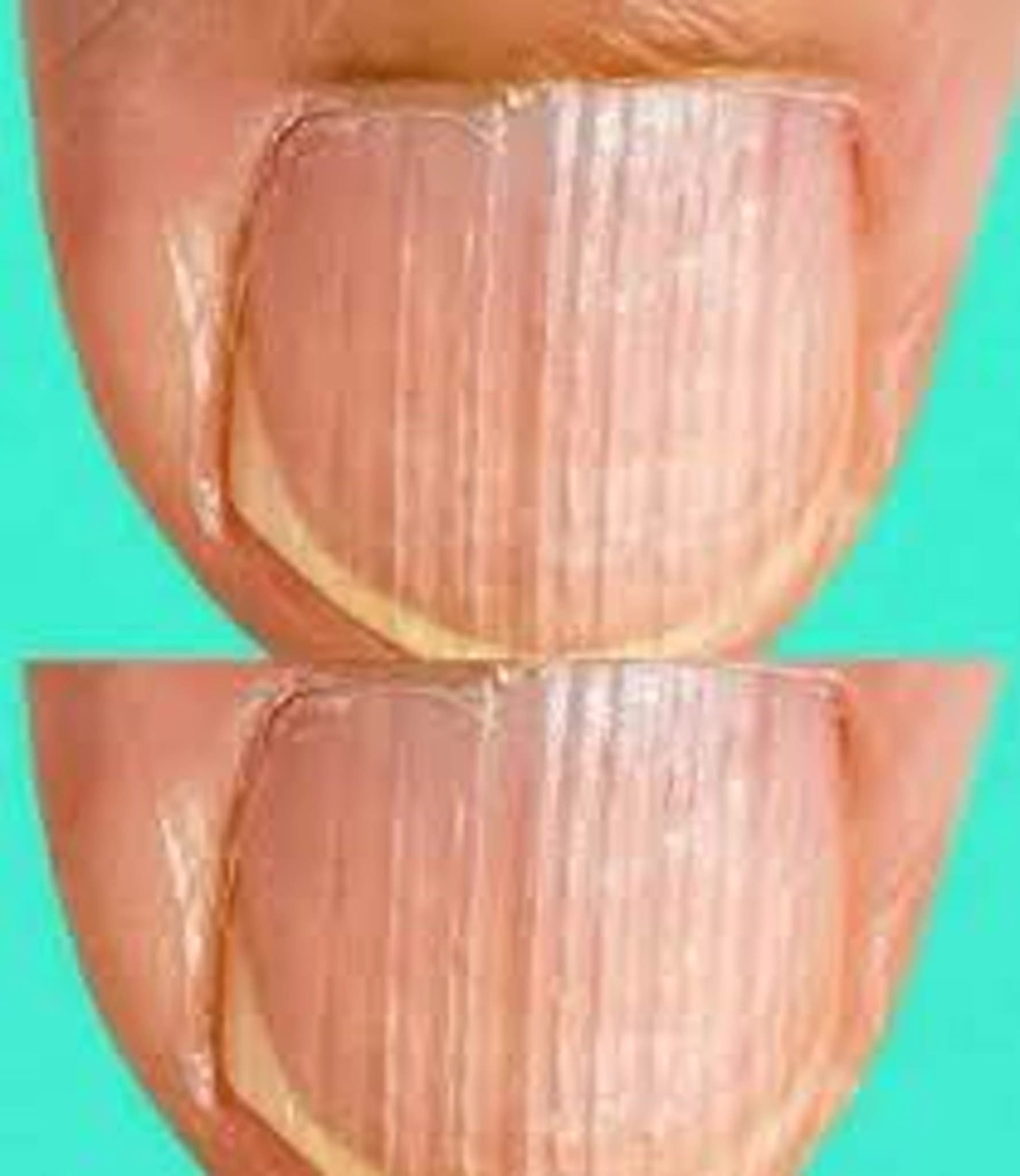 Having Striped Nails Could Mean That Your Body is…. See more