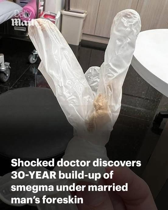 Shocked doctor discovers 30-YEAR build-up of smegma under the foreskin of married man who was suffering agonising pain in his pe.nis