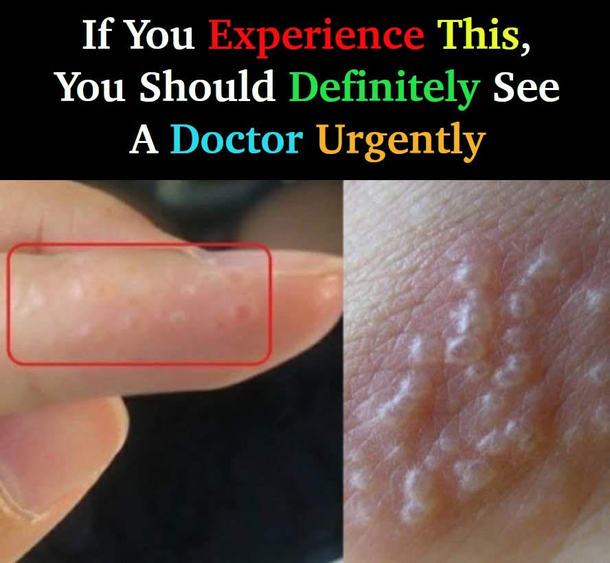 If You See These Painful Red Bumps, You May Have Dyshidrotic Eczema… See more