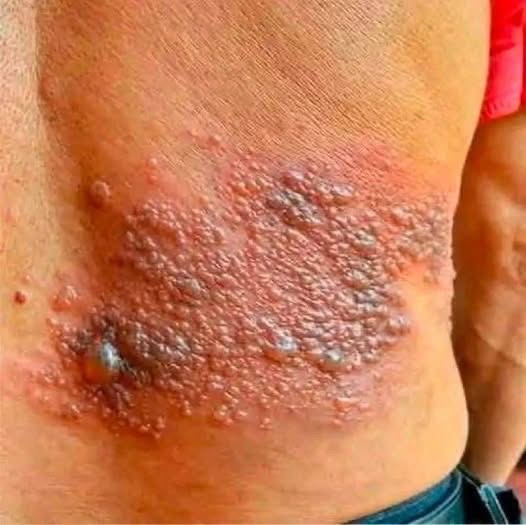 “It Was Itching His Body, He Thought It Was an Allergy, But a Tough Diagnosis…”