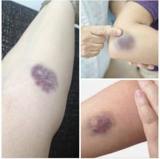 Understanding Bruises: Causes, Types, and Effective Treatments