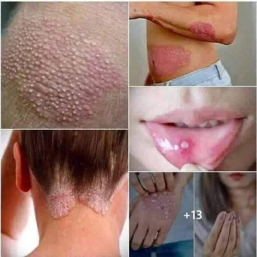 Signs Of Human Papillomavirus You Should Know