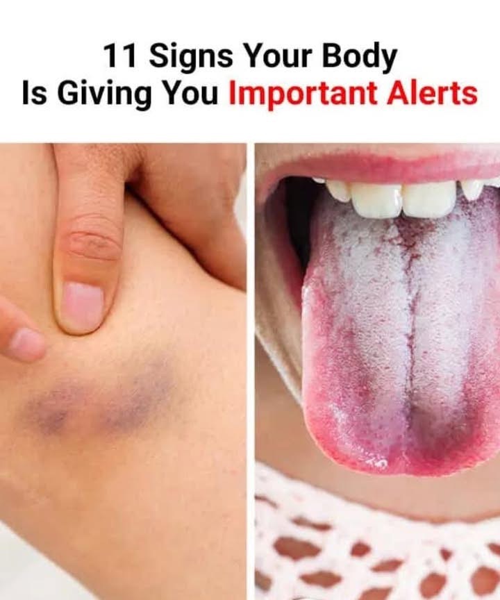 If your tongue is white, this is a clear sign that you are suffering from…