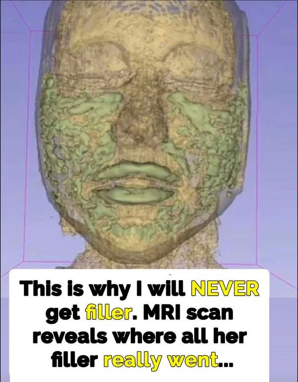 Plastic surgeon reveals damage fillers do in long term