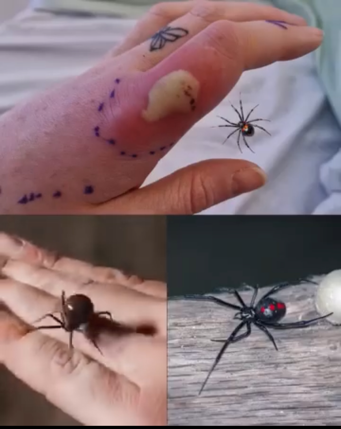 What to do if you get bit.ten by a black widow spider: A complete guide