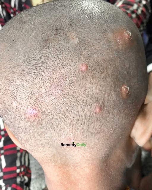 Found these bumps on my son’s scalp. Doctor appt is so far away. What’s should I do? They look really painfu