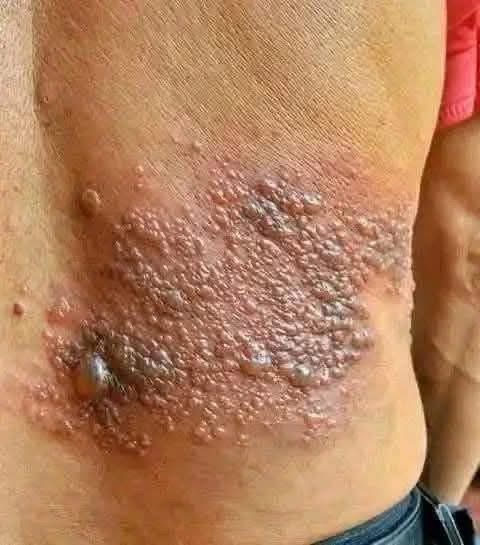 Young woman dies at the hands of her…See moreIt was itching his body, he thought it was an allergy, but a tough diagnosis