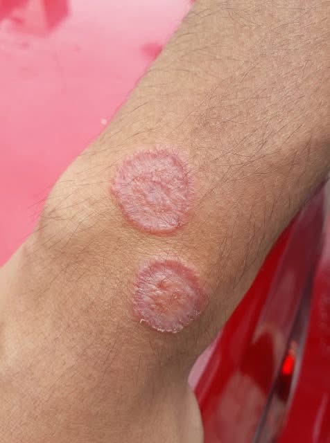 Ringworm (Tinea Corporis): Causes, Symptoms, Treatment, And Prevention