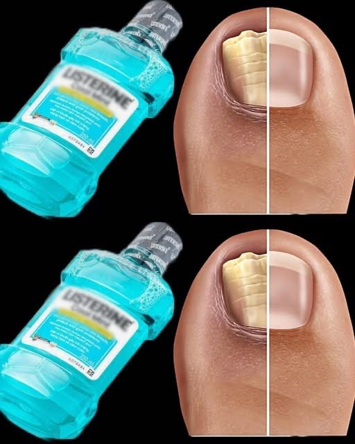 Say Goodbye To Nail Fungus With This Simple Home Remedy