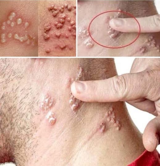 A Man Wakes Up With Small Bubbles On His Finger – After Examining Him, Doctors Called The Police