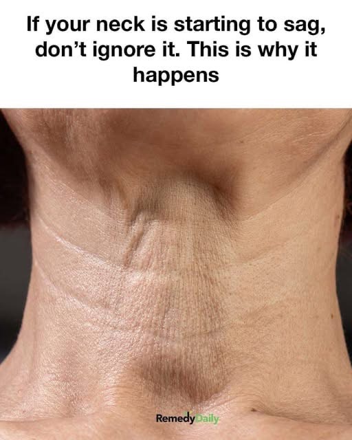 If your neck is starting to sag, don’t ignore it. This is why it happens
