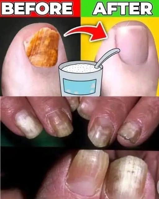 Say Goodbye Nail Fungus naturally with simple remedies. The Best Natural Anti-Fungal That Must Try…