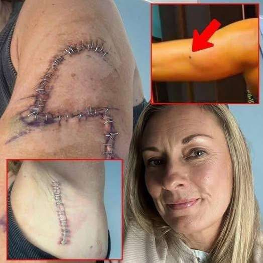 She Thought It Was Just A Mole… 77 Stitches Later, Doctors Told Her The Truth…