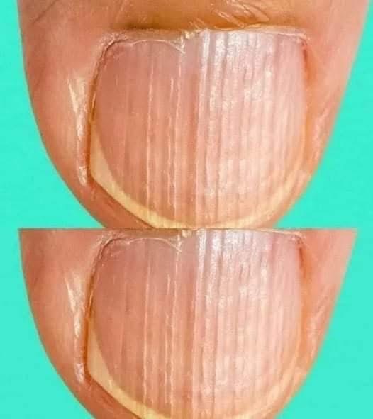 Rippled fingernails reveal secrets of possible disease.