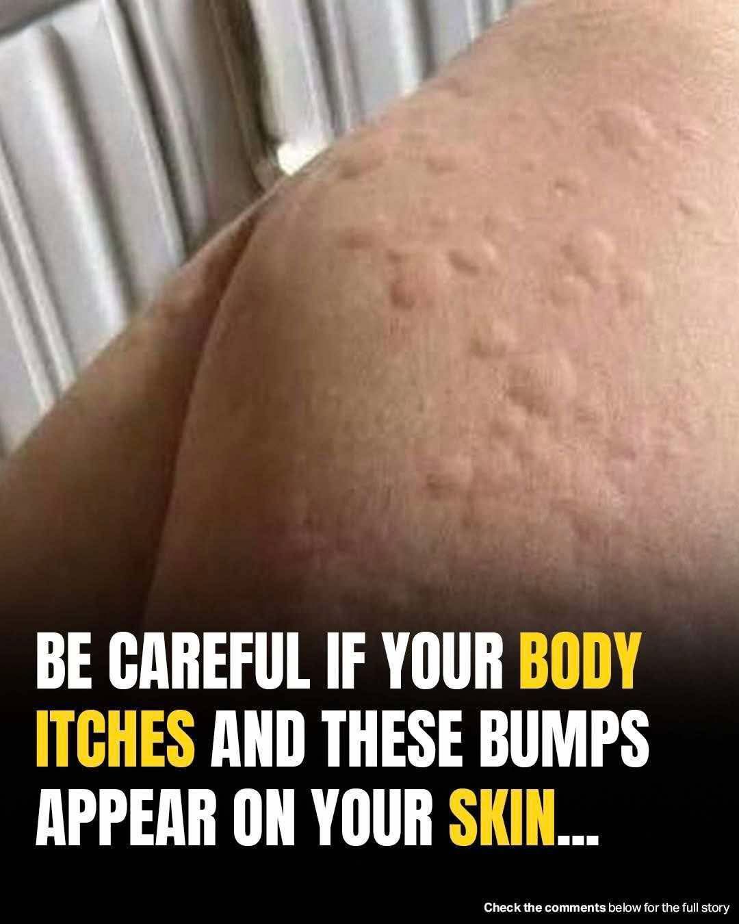 What’s really causing your hives? Uncover these unexpected triggers