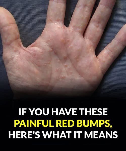 If You See These Painful Red Bumps, Here’s What It Really Means