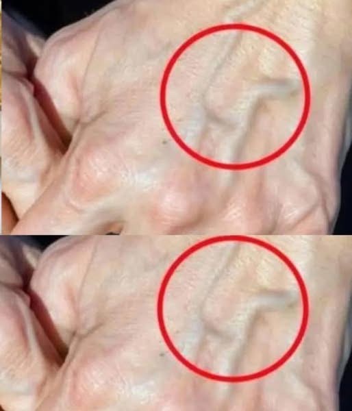 When should you be concerned about suddenly appearing veins?