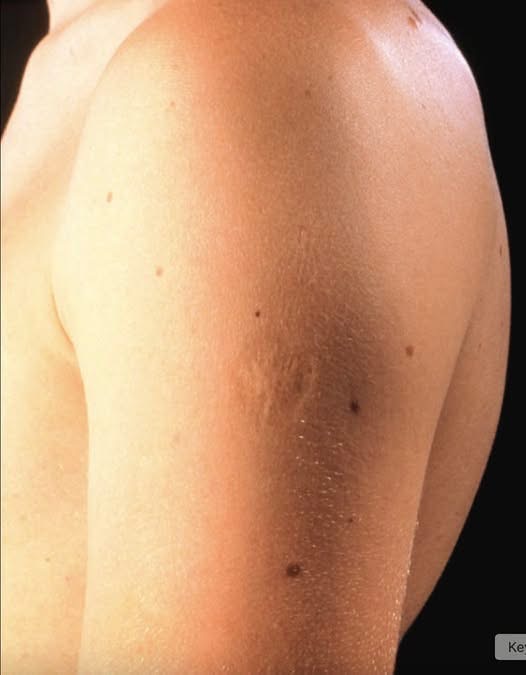 Here’s The Truth Behind This Scar On People’s Upper Left Arm