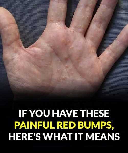 If You See These Painful Red Bumps, Here’s What It Really Means