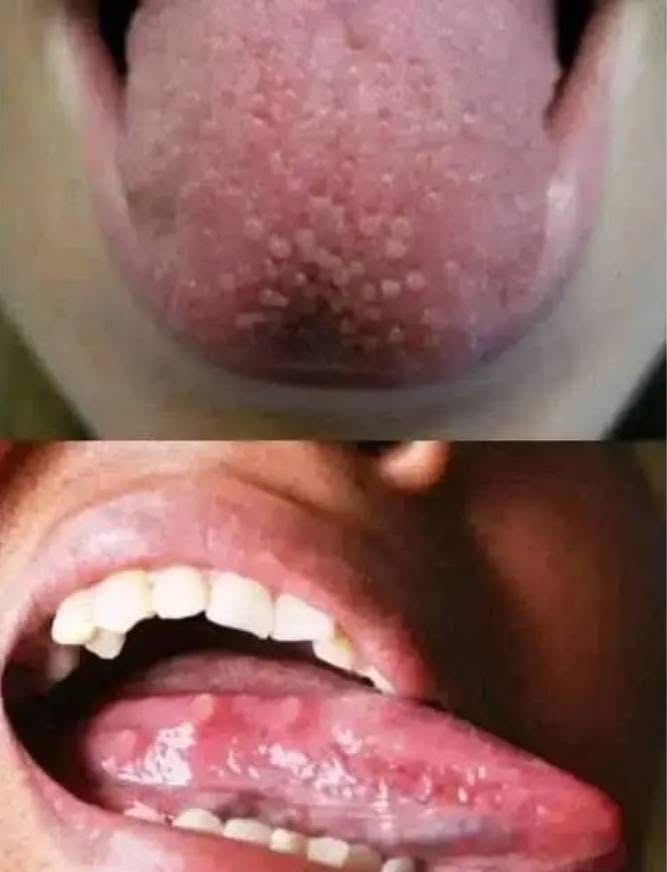 If you have these little balls on your tongue, worry, it’s a sign of