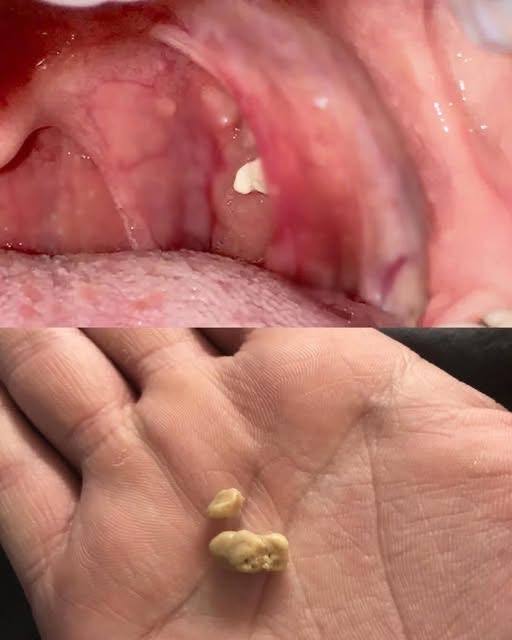 Why do we have white lumps in our throat?