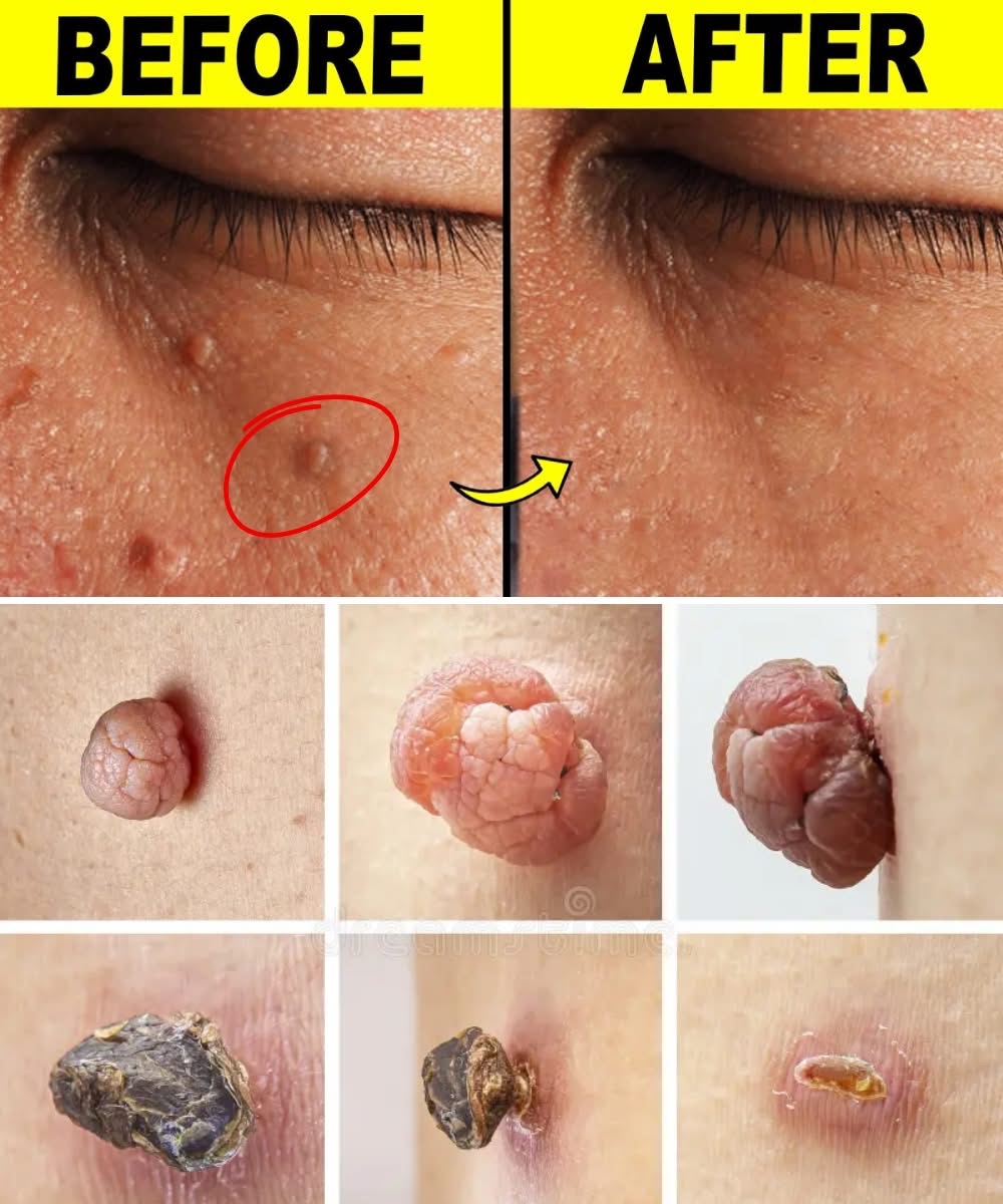 8 Natural Ways to Get Rid of Milia (White Bumps) Using Simple Home Ingredients