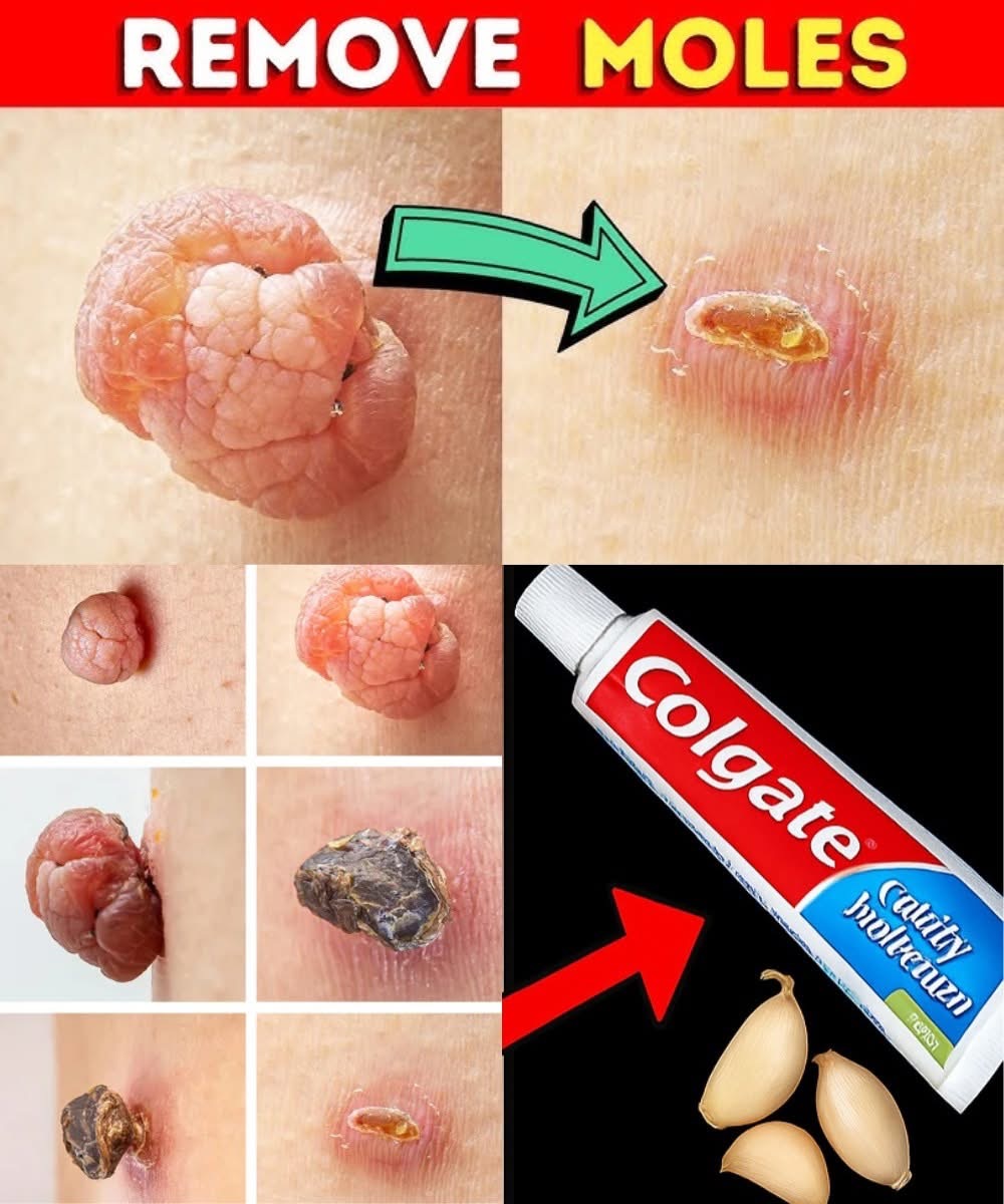 A Gentle Home Remedy for Skin Tags and Plantar Warts