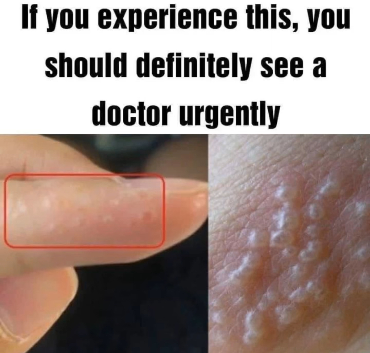 Persistent Itchy Blisters on Your Hands or Feet? Understanding Dyshidrotic Eczema