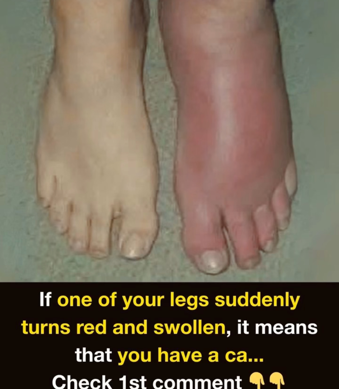 Sudden Redness and Swelling in One Leg: Causes and What to Know