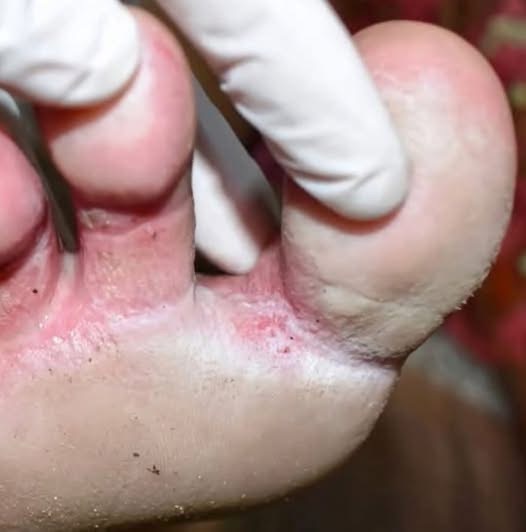 Looks Like An Infection Between My Toes. Couldn’t See A Doctor, So I…
