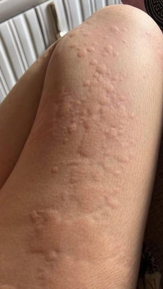 Her Whole Body Was Itchy: What She Thought Was A Common Allergy Was Hiding Something More Serious