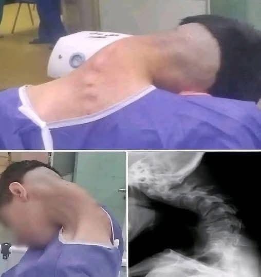 A Life-Altering Incident: Heavy Object Falling on Head Caused Fatal Cervical Spine Fracture in 18-Year-Old Worker
