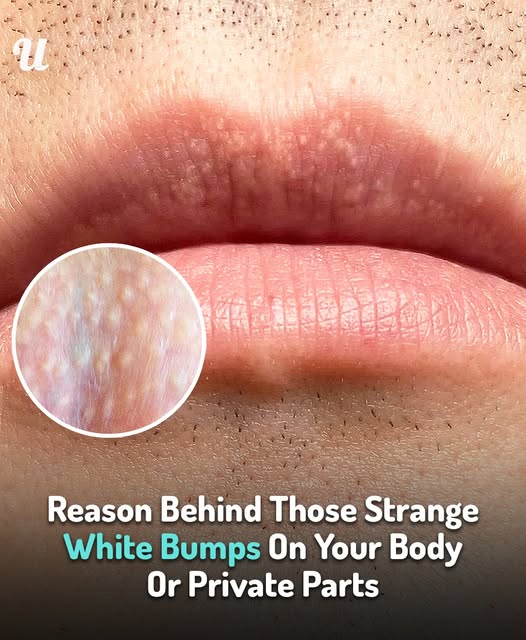 Reason Behind Those Strange White Bumps On Your Body Or Private Parts
