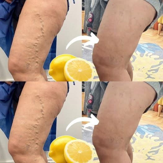 Natural Lemon Remedy for Varicose Veins: Simple and Effective