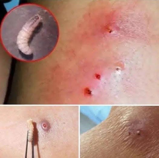 Larvae Found in Woman