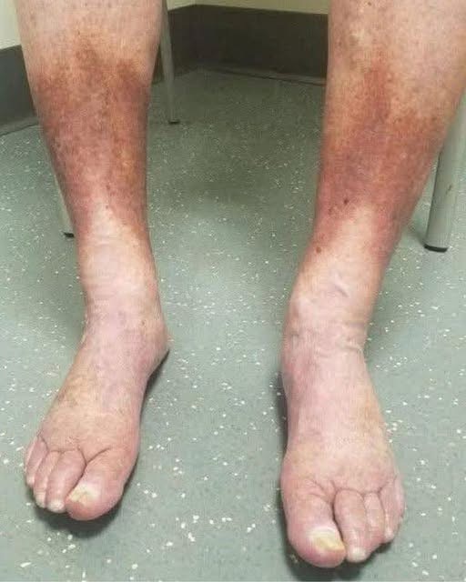 Signs on your FEET that indicate your veins…