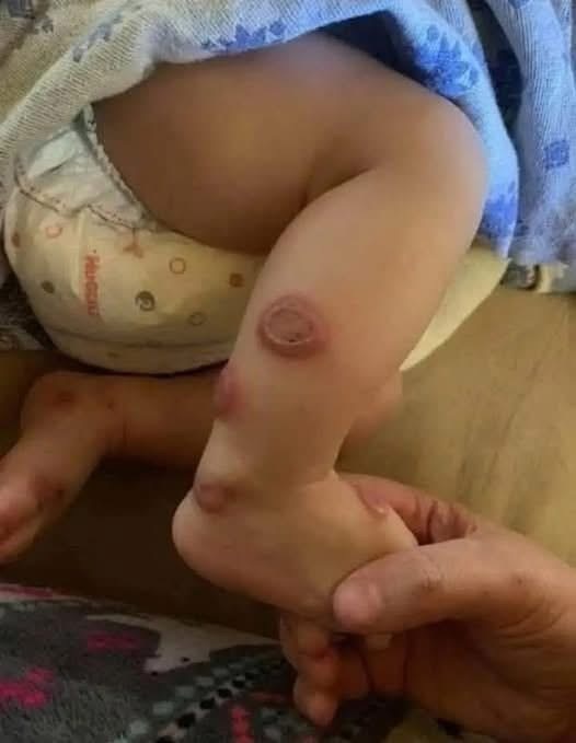 A Skin Condition with Whole-Body Effects: A Case of Sweet Syndrome