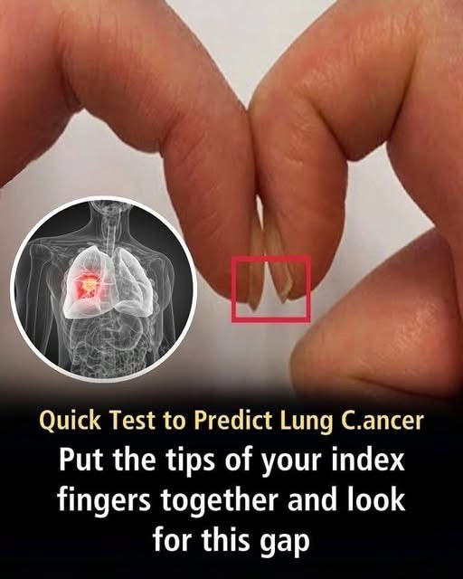 Finger Test For Lung Cancer Could Determine Cancer Risk