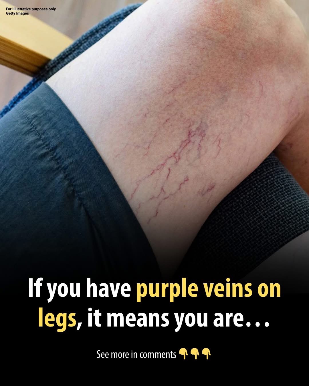 Purple Veins on Your Legs